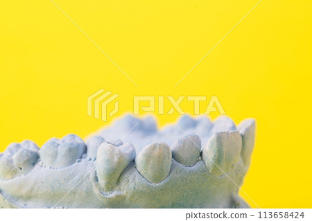 Blue plaster model of an impression of a patient's jaw at an orthodontist dentist on a yellow background. Manufacturing of dentures and crowns for dental prosthetics in orthodontics, macro. Copy space 113658424