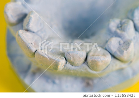 Blue plaster model of an impression of a patient s jaw at an orthodontist s dentist, close-up. Crooked teeth, correction of malocclusion, macro Blue plaster model of an impression of a patient s jaw at an orthodontist s dentist, close-up. Crooked teeth, correction of malocclusion, macro 113658425
