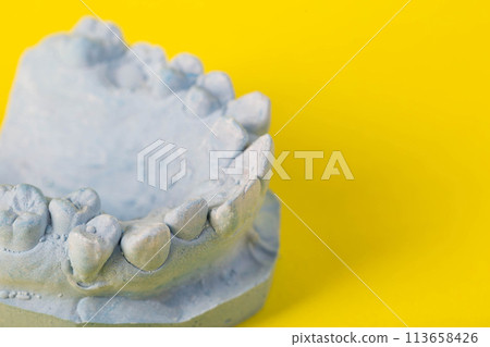 Blue plaster model of an impression of a patient's jaw at an orthodontist dentist on a yellow background. Manufacturing of dentures and crowns for dental prosthetics in orthodontics, macro. Copy space Blue plaster model of an impression of a patient's jaw at an orthodontist dentist on a yellow background. Manufacturing of dentures and crowns for dental prosthetics in orthodontics, macro. Copy space 113658426