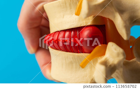 Convex red intervertebral disc herniation on a model of the spine. Treatment of problems and diseases of the spine. Orthopedics and vertebrology, close-up 113658702