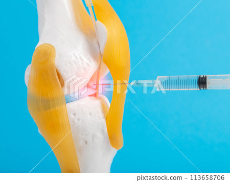 Drug blockade in a mock-up of the knee joint on a blue background. The concept of treating joints with blood plasma, plasma lifting. Introduction of hylaronic acid for joint rejuvenation. Copy space 113658706