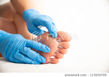 A doctor covers calluses on a person s foot with a special plaster. Copy space for text, papilloma A doctor covers calluses on a person s foot with a special plaster. Copy space for text, papilloma 113658709