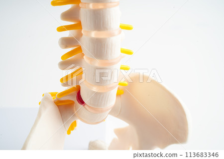 Lumbar spine displaced herniated disc fragment, spinal nerve and bone. Model for treatment medical in the orthopedic department. Lumbar spine displaced herniated disc fragment, spinal nerve and bone. Model for treatment medical in the orthopedic department. 113683346