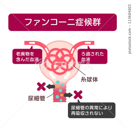 Fanconi syndrome causes and mechanisms vector illustration 113684803