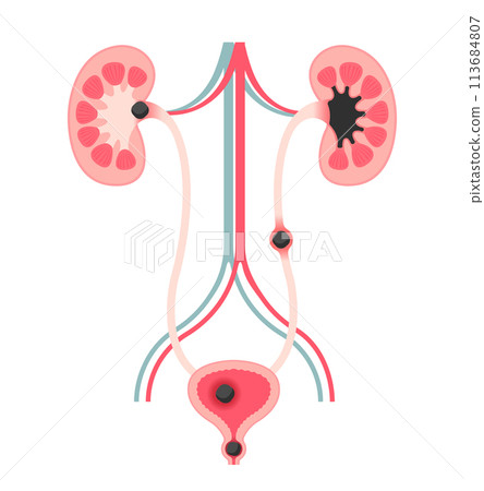 Types of urinary stones Vector illustration (without text) 113684807