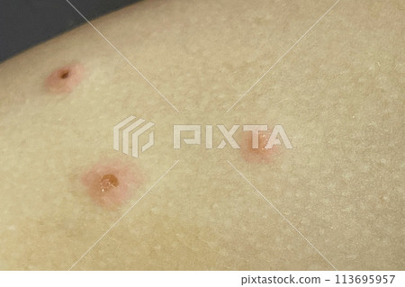 Scratched pimples on human skin. Infectious disease. Dermatology,  medicine and health care concept. 113695957