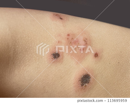 Human skin with scratched pimples. Allergy, dermatitis, virus or bacterial infection. Human skin with scratched pimples. Allergy, dermatitis, virus or bacterial infection. 113695959