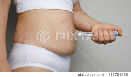 Self injection. Female model with injection pen close up. Medicine and treatment concept 113701686