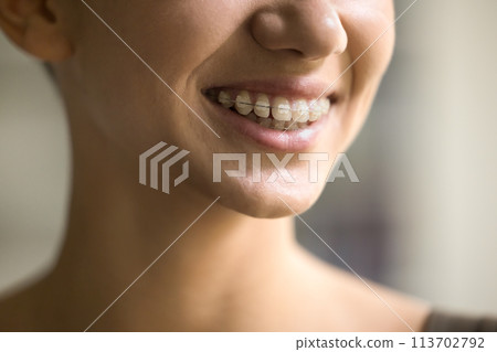 Young woman with metal brackets on teeth, close up 113702792