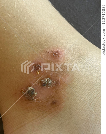 Bacterial infection. Human leg closeup Bacterial infection. Human leg closeup 113715885