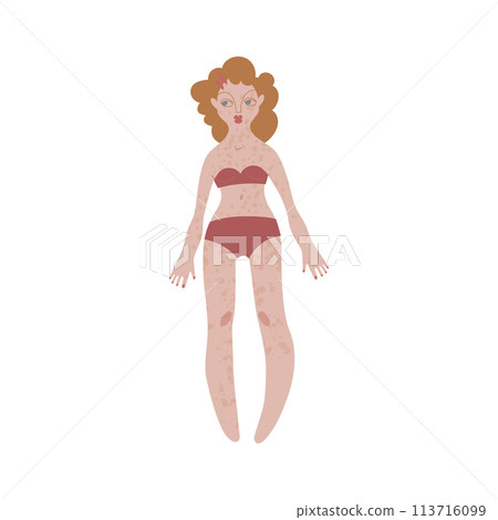 Flat Irish woman in underwear. Pale ad freckled skin person with redhead in cartoon style for multinational and diversity designs. Vector illustration. 113716099