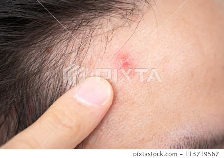 Men's beauty rough skin trouble Men's beauty rough skin trouble 113719567