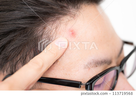 男士美容皮膚粗糙煩惱 113719568