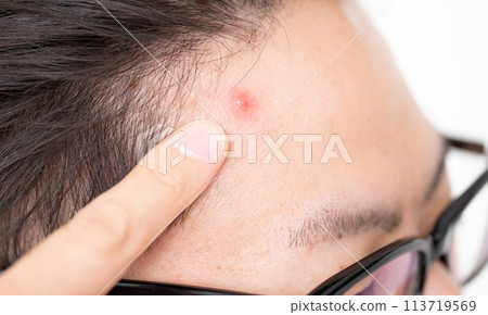 男士美容皮膚粗糙煩惱 113719569