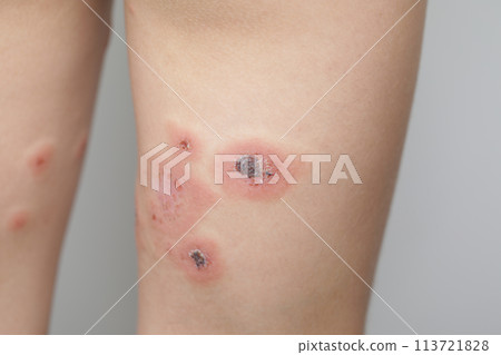 Female leg closeup. Body with skin problem. Infectious disease. Allergy, dermatitis, virus Female leg closeup. Body with skin problem. Infectious disease. Allergy, dermatitis, virus 113721828