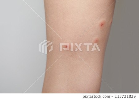 Female leg with skin problem close-up. Infectious disease. Allergy, dermatitis, virus Female leg with skin problem close-up. Infectious disease. Allergy, dermatitis, virus 113721829