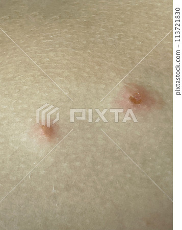 Body with skin problem closeup. Infectious disease. Allergy, dermatitis, virus  113721830
