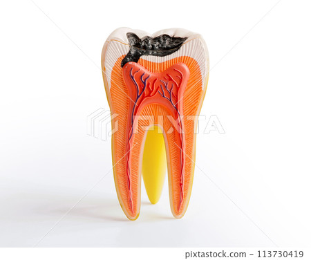 Decay tooth replace with dental implant root canal teeth model for education isolated on white background with clipping path. Decay tooth replace with dental implant root canal teeth model for education isolated on white background with clipping path. 113730419