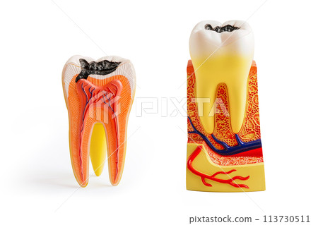Decay tooth replace with dental implant root canal teeth model for education isolated on white background. 113730511