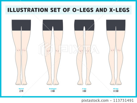 O型腿、X型腿、XO型腿和正常腿的插圖素材集 O型腿、X型腿、XO型腿和正常腿的插圖素材集 113731491