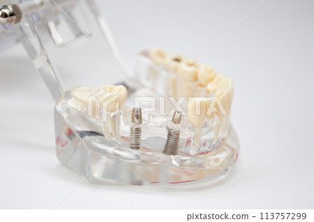 A demonstration jaw with an implants teeth and an abutment 113757299