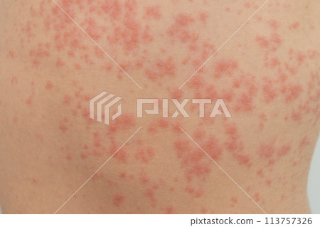 Urticaria is an allergic reaction on the skin. Red spots on the skin 113757326