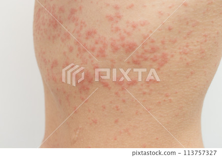 acute Urticaria allergy on woman's back 113757327