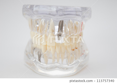 A demonstration jaw with an implant and an abutment 113757340