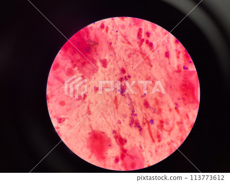 Mold yeast cell in sputum gram stain. 113773612