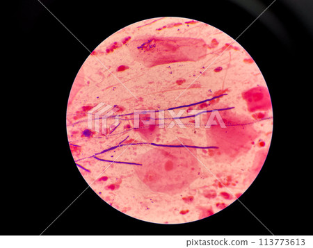 Mold yeast cell in sputum gram stain. 113773613