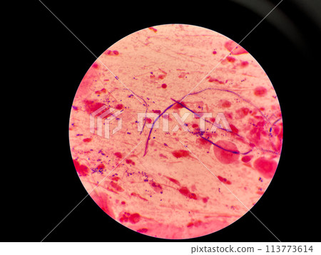 Mold yeast cell in sputum gram stain. Mold yeast cell in sputum gram stain. 113773614