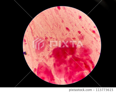 Mold yeast cell in sputum gram stain. 113773615
