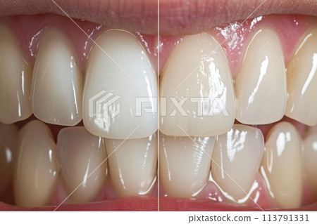 Before and after dental enamel erosion treatment close-up of teeth 113791331