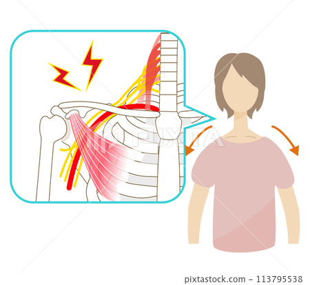 Woman with stroked shoulder suffering from thoracic outlet syndrome pain Woman with stroked shoulder suffering from thoracic outlet syndrome pain 113795538