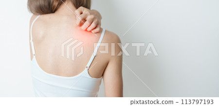 woman itching and scratching itchy back. Sensitive Skin Allergic reaction to insect bite, food, drug dermatitis. Dermatology, Leprosy, Systemic lupus erythematosus, Allergy symptoms and rash Eczema 113797193