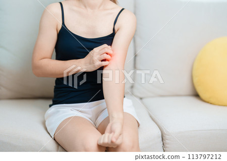 woman itching and scratching itchy arm. Sensitive Skin Allergic reaction to insect bite, food, drug dermatitis. Dermatology, Leprosy day, Systemic lupus erythematosus, Allergy symptoms and rash Eczema 113797212