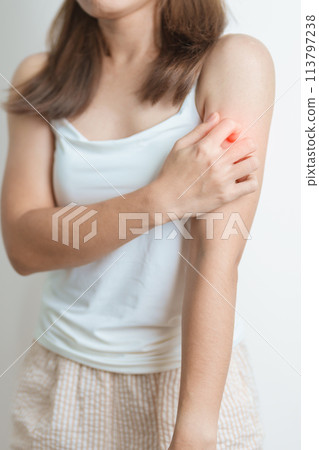 woman itching and scratching itchy arm. Sensitive Skin Allergic reaction to insect bite, food, drug dermatitis. Dermatology, Leprosy day, Systemic lupus erythematosus, Allergy symptoms and rash Eczema 113797238