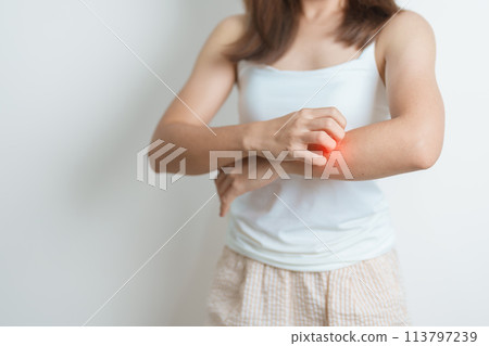woman itching and scratching itchy arm. Sensitive Skin Allergic reaction to insect bite, food, drug dermatitis. Dermatology, Leprosy day, Systemic lupus erythematosus, Allergy symptoms and rash Eczema 113797239