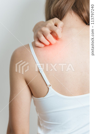 woman itching and scratching itchy back. Sensitive Skin Allergic reaction to insect bite, food, drug dermatitis. Dermatology, Leprosy, Systemic lupus erythematosus, Allergy symptoms and rash Eczema 113797240