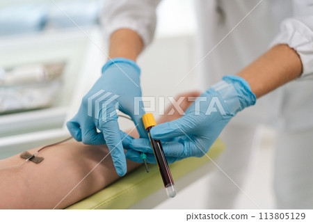 Unrecognizable female lab assistant in blue medical gloves taking venous blood from arm of woman patient for examination or PRP procedure. Concept of laboratory research, medicine, analysis 113805129