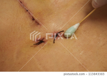 doctor using alcohol and cotton bud cleaning wound from open heart surgery on female body (Heart Valve Regurgitation) 113843383