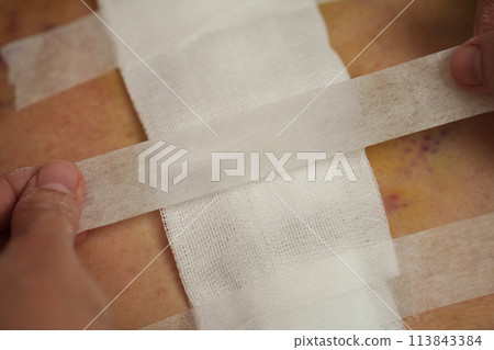 doctor is bandaging of patient after cleaning wound from heart surgery (Heart Valve Regurgitation) doctor is bandaging of patient after cleaning wound from heart surgery (Heart Valve Regurgitation) 113843384