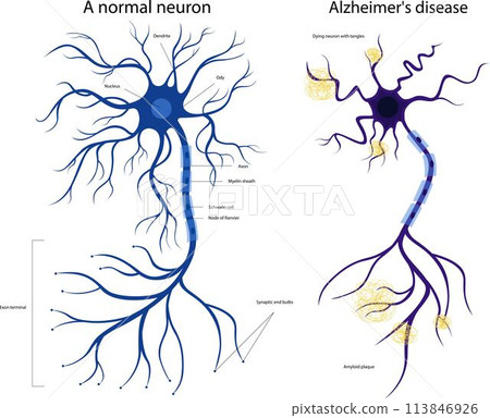 The structure of a sick and healthy neuron. Damaged neuron. Alzheimers disease. Brain disease dementia, memory disorders. A neuron in Alzheimer's disease 113846926