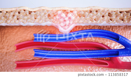 Early Stage Breast Cancer 3D Rendering 113858317