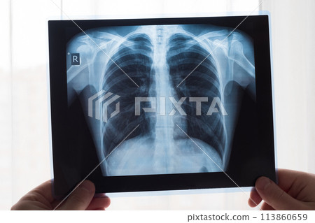 Lung radiography concept. Radiology doctor examining at chest x ray film of patient Lung Cancer or Pneumonia. Virus and bacteria infected the Human lungs. Patient with Lung Cancer or Pneumonia 113860659