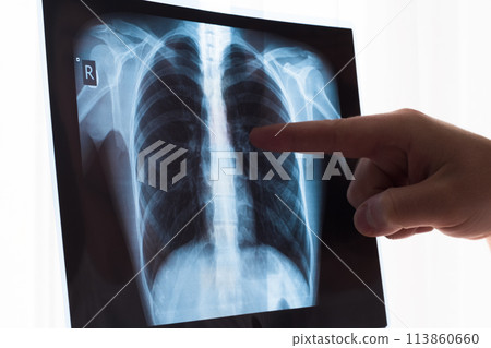 Lung radiography concept. Radiology doctor examining at chest x ray film of patient Lung Cancer or Pneumonia. Virus and bacteria infected the Human lungs. Patient with Lung Cancer or Pneumonia Lung radiography concept. Radiology doctor examining at chest x ray film of patient Lung Cancer or Pneumonia. Virus and bacteria infected the Human lungs. Patient with Lung Cancer or Pneumonia 113860660