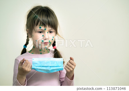 Child girl wearing blue protective medical mask ill with chickenpox, measles or rubella virus with rashes on body. Children protection during epidemic of coronovirus. Covid-19 contagion concept. Child girl wearing blue protective medical mask ill with chickenpox, measles or rubella virus with rashes on body. Children protection during epidemic of coronovirus. Covid-19 contagion concept. 113871046