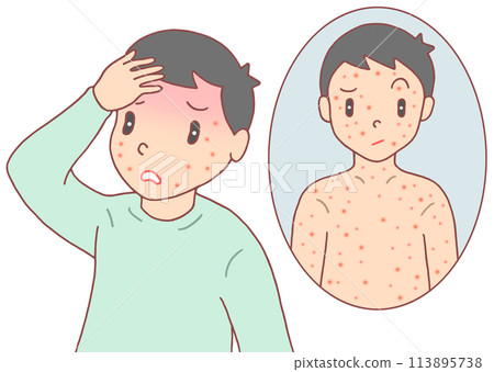 Illness, disease and illness - Measles, rash and fever in adults 113895738