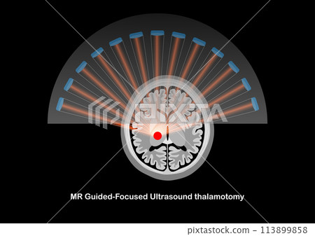 MR-guided focused ultrasound thalamotomy for the treatment of tremor. 113899858