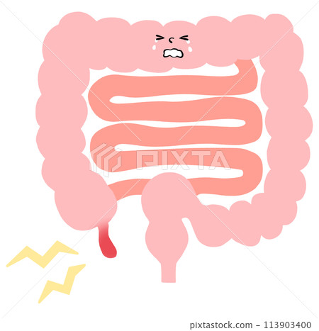 Illustration of acute appendicitis 113903400